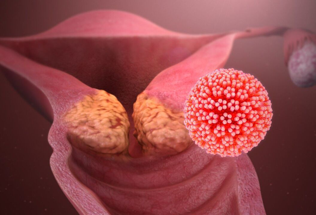 Uszkodzenie szyjki macicy spowodowane wirusem HPV