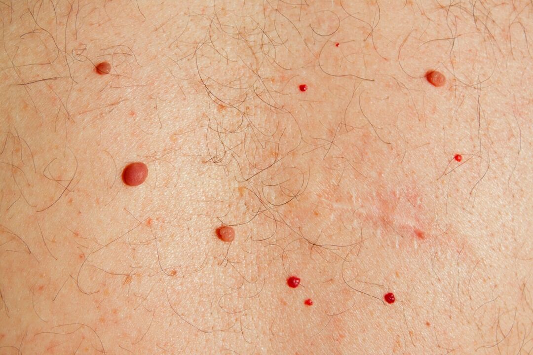 Brodawki na ciele spowodowane przez HPV